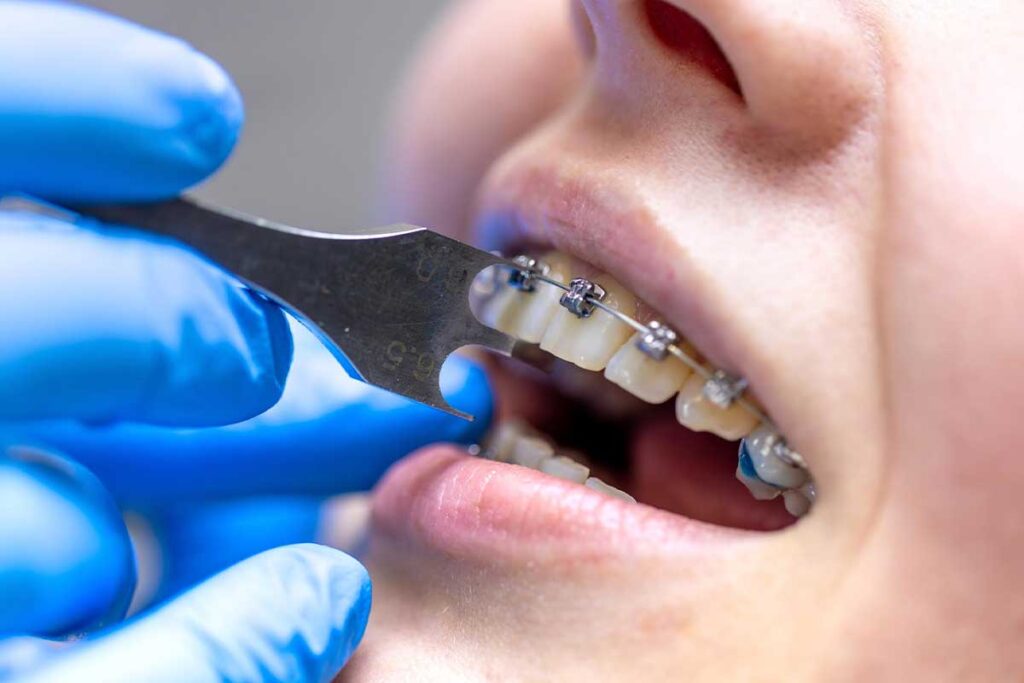 Orthodontic Treatment Options at Solara Dental Studio