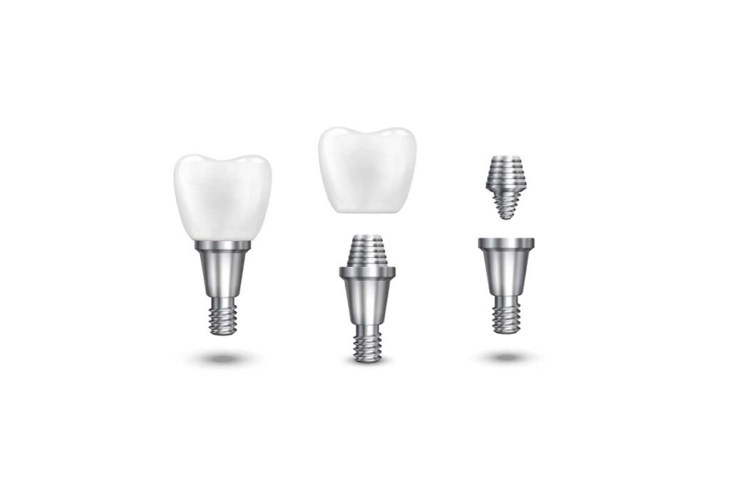 Why Dental Implants in Winter Garden Are an Investment in Your Health